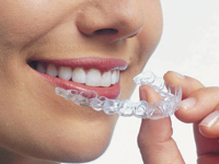 Invisible Braces to create a perfect smile